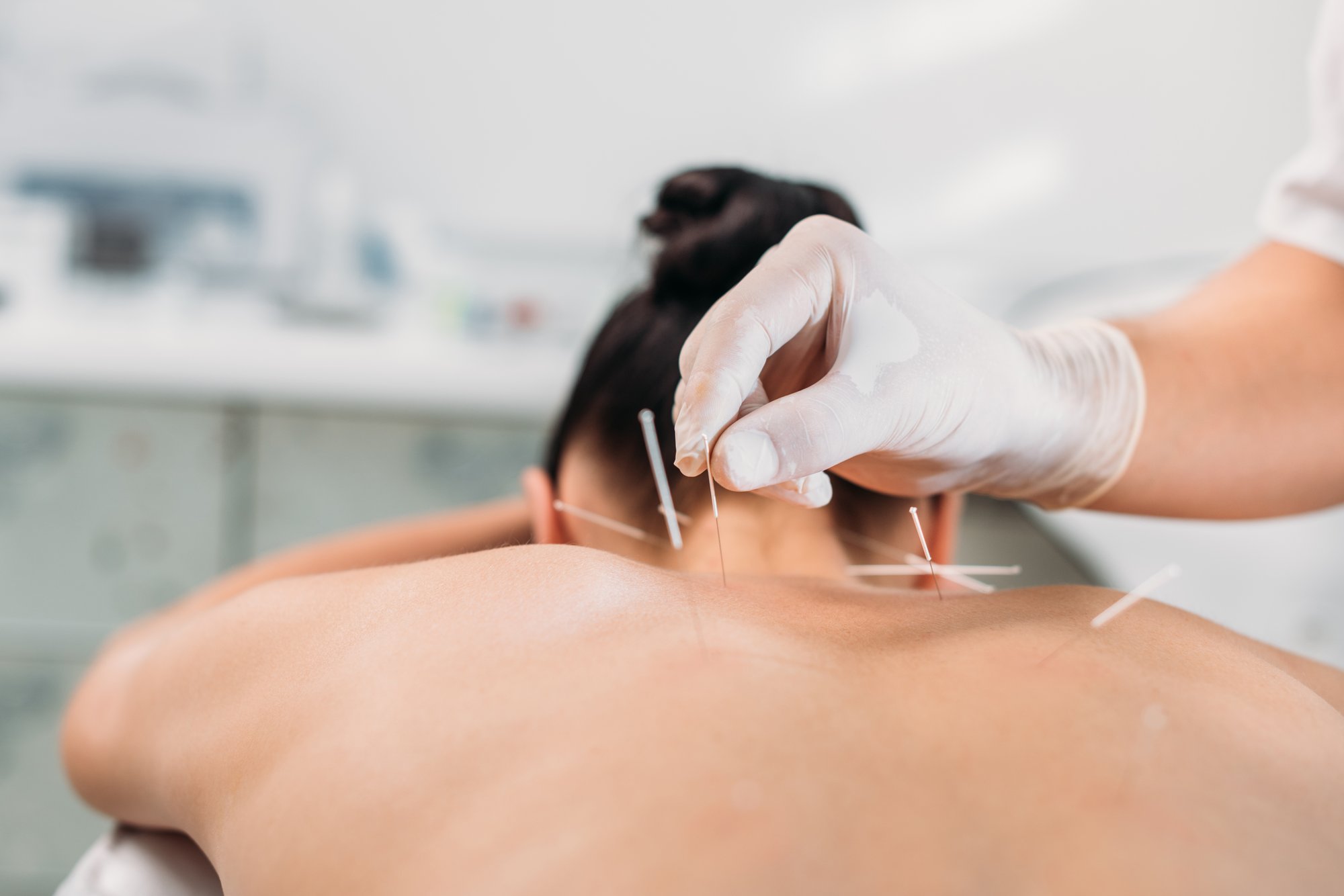 dry-needling-therapy-gainesville-FL