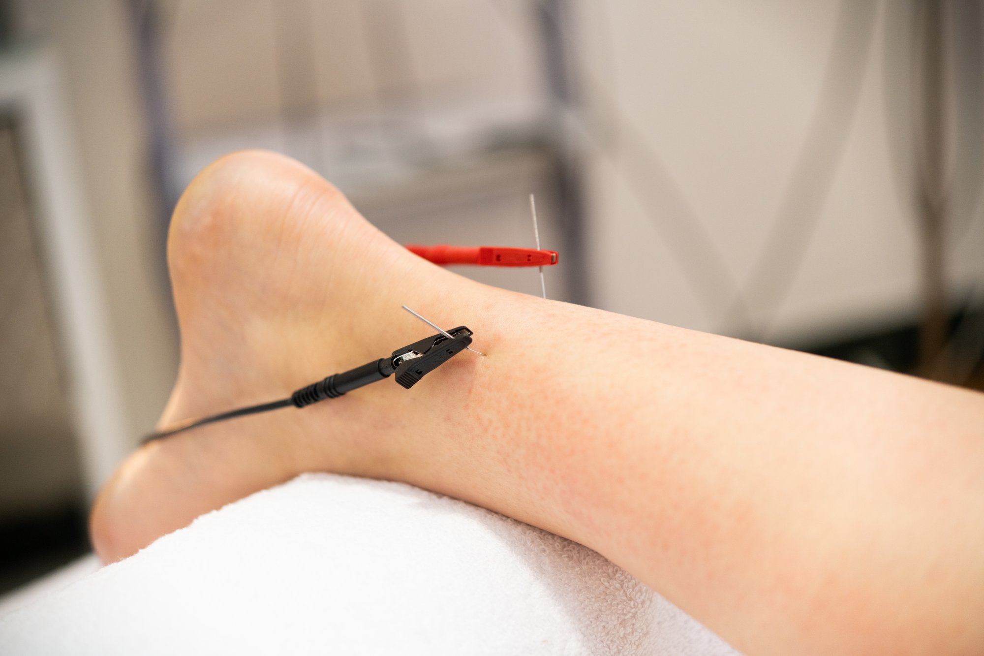 dry-needling-therapy-gainesville-FL