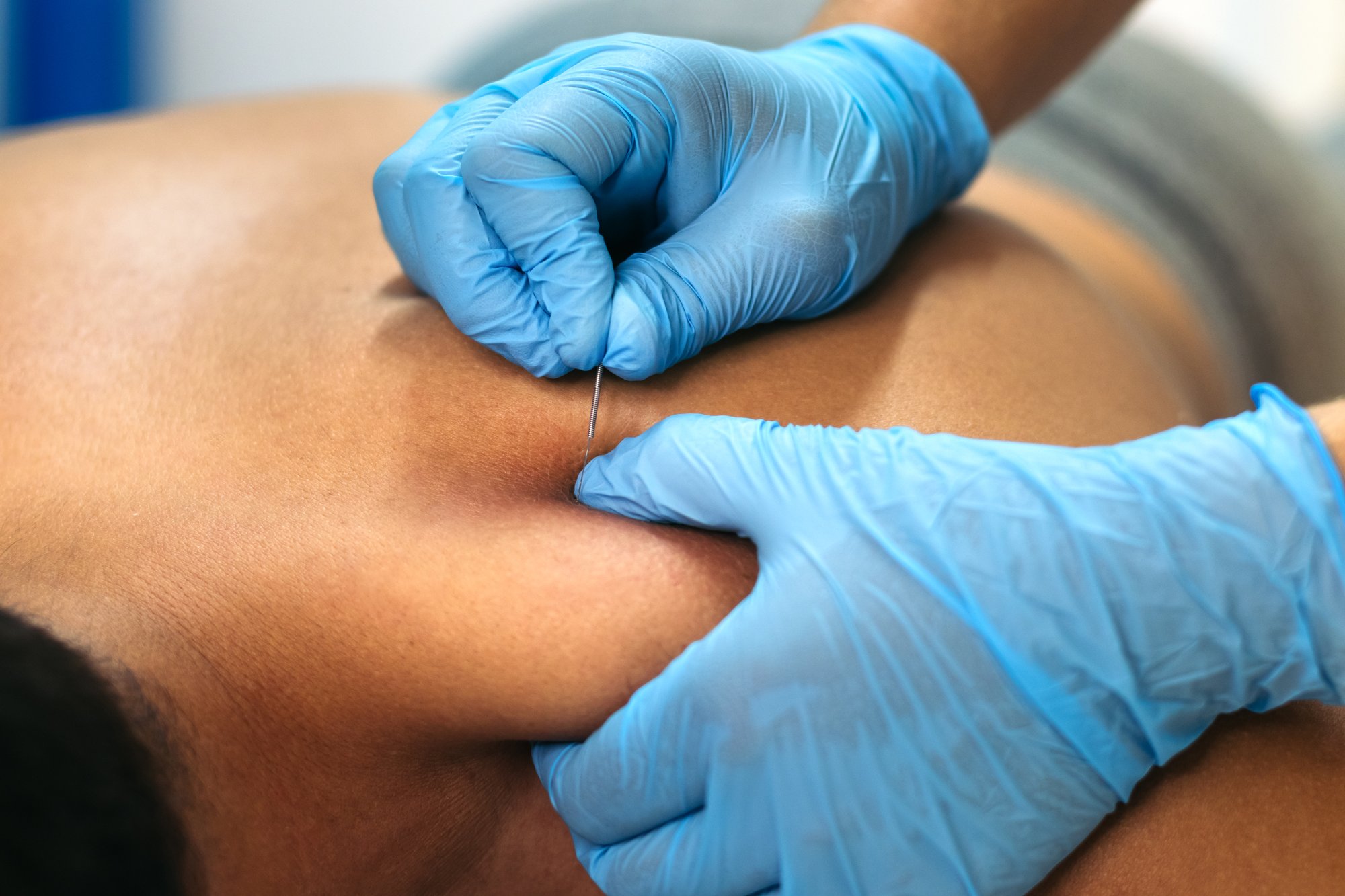 dry-needling-therapy-gainesville-FL