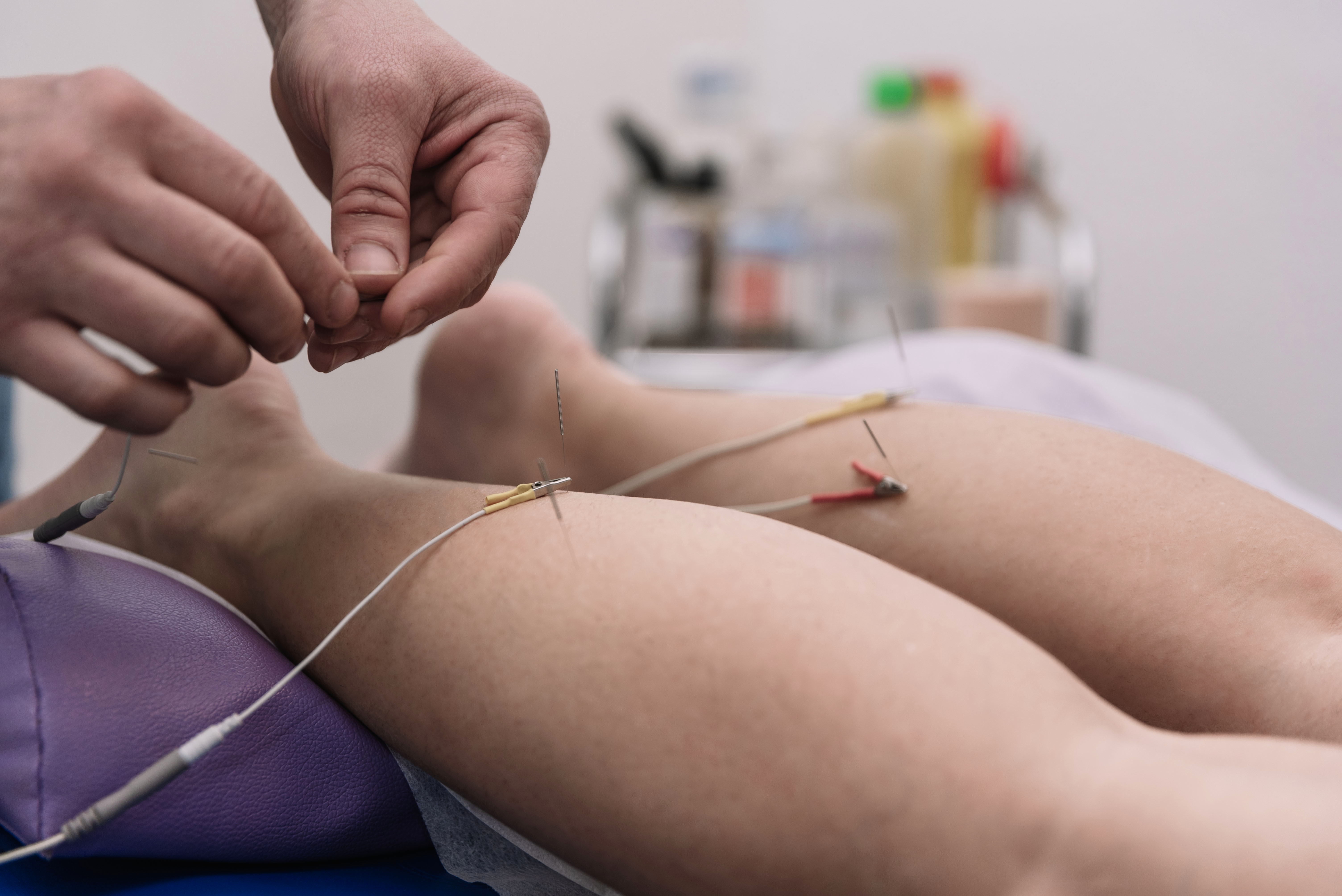 dry-needling-therapy-gainesville-FL